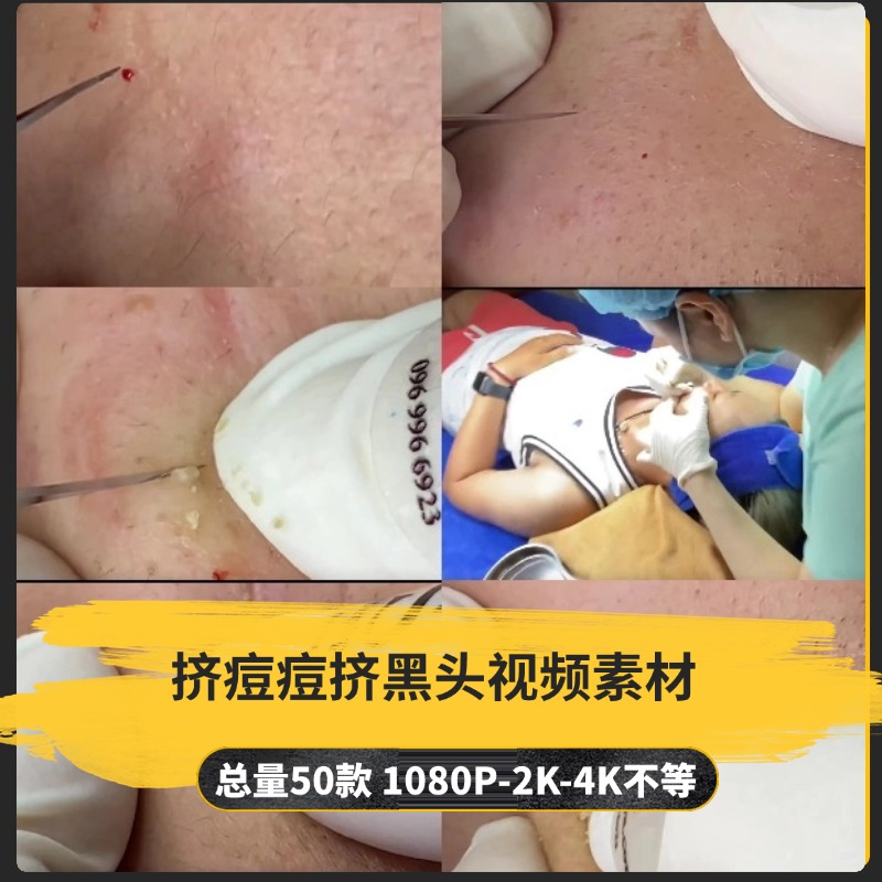 【50款】挤痘痘挤黑头解压视频素材-捷亚素材网